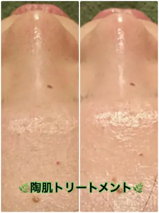 【リベルハーブピーリング認定店】敏感肌・美白脱毛専門店Dione立川店所属・Dione 立川店のエステ・リラクイメージ