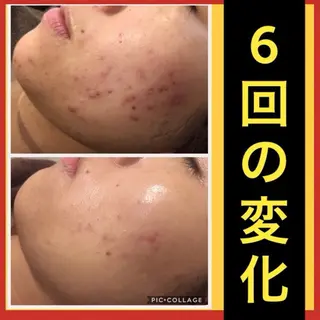 学生ニキビ改善🍀 優しい肌質改善のエステ・リラクイメージ