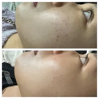 小顔・毛穴/ニキビ/ ハーブピーリング専門のエステ・リラクイメージ