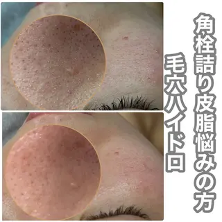 Chalon所属・REVI取扱・肌悩み 毛穴Chalonのエステ・リラクイメージ