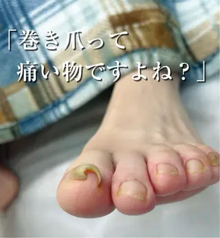 巻き爪フットケアサロンKotori所属・フットケアサロン Kotoriのその他イメージ