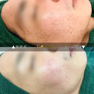 BLANC.【新宿店】所属・ハーブピーリング ayamiのエステ・リラクイメージ