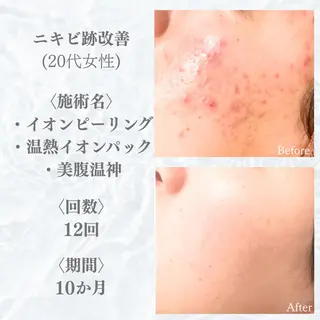 6万人の美肌実績🔥 最短ニキビ改善のエステ・リラクイメージ