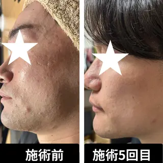 ニキビケア専門店ハーブピーリングHY所属・はが ゆかのエステ・リラクイメージ