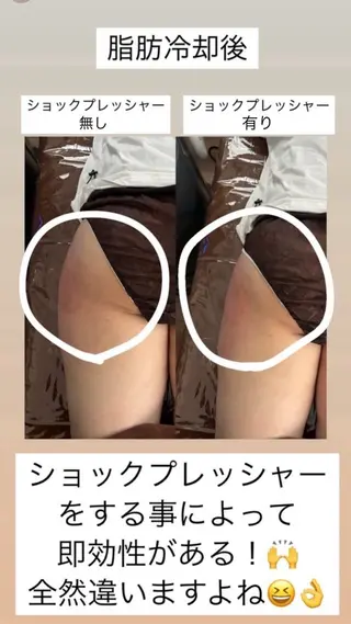 Miiju.所属・Miiju. 石巻市 脂肪冷却  鈴木のエステ・リラクイメージ