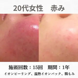 重度ニキビ専門🌷 ダウンタイムなしのエステ・リラクイメージ