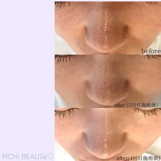 タルミ,ニキビケア専門PICHi BEAUTeピチボーテ所属・トクシゲ マホのエステ・リラクイメージ