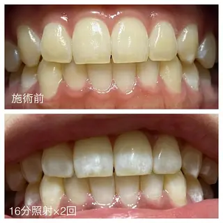 ネイル/耳つぼ /新ホワイトニングのネイルデザイン