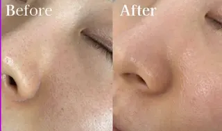 エイジングケアサロンBIOEL所属・肌質改善BIOELプ ラズマ/ラミピールのエステ・リラクイメージ