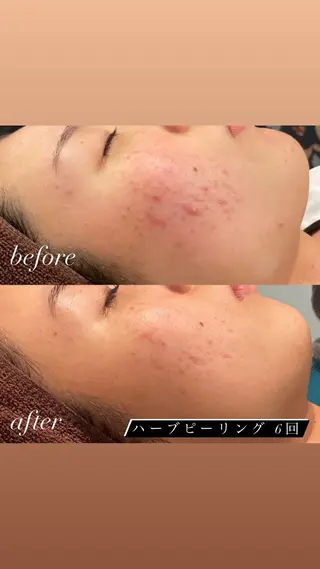 美容鍼＆鍼灸サロン 鍼Glitter.所属・田中 美奈のエステ・リラクイメージ