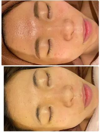 ニキビ跡改善専門🔥 医療にはできない改善のエステ・リラクイメージ