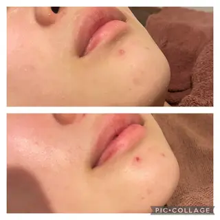 ミディアム カラー パーマ ヘアアレンジ メンズ キッズ ネイル マツエク・マツパ アイブロウ ニキビ特化型エステ 🍓最短で肌質改善のエステ・リラクイメージ