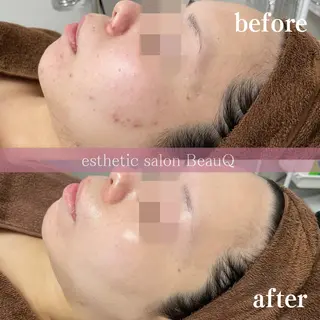 肌質改善/ブライダル 水上百華のエステ・リラクイメージ