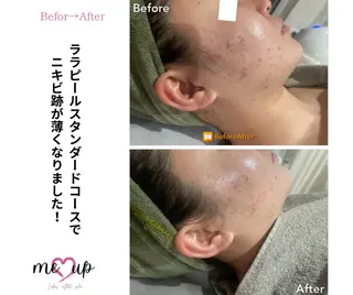 Meupニキビ専門店 背中/ハーブ/肌管理のその他イメージ