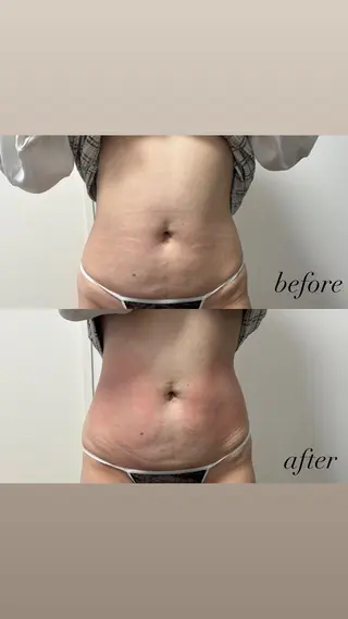 Miiju.所属・Miiju. 石巻市 脂肪冷却  鈴木のエステ・リラクイメージ