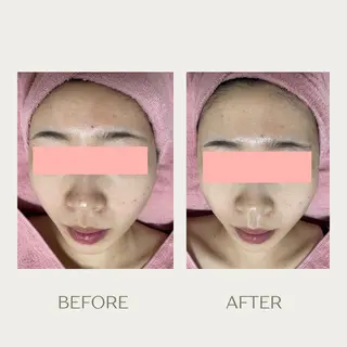 ピーリングケア 🤍moekoのエステ・リラクイメージ