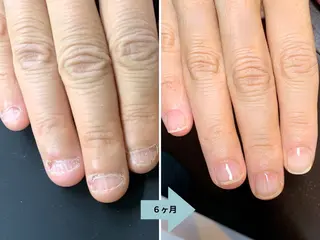ネイル 深爪矯正・自爪育成 ネイルサロンアモここのネイルデザイン