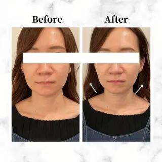 12Dハイフ💗 最強小顔のエステ・リラクイメージ