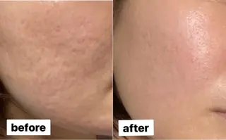 Beauty salon ~Ohana~所属・【ニキビ肌改善】 肌質改善Ohanaのエステ・リラクイメージ