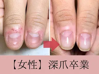 ネイル 深爪矯正・自爪育成 ネイルサロンアモここのネイルデザイン