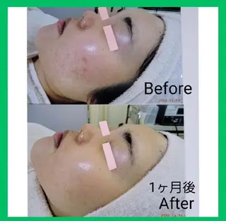 ニキビケア◇ニキビ跡 レゾン京橋店　峠山のエステ・リラクイメージ