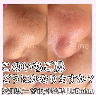 Reine BeautySalon所属・毛穴/シミ肝斑/脱毛 横山梨里のエステ・リラクイメージ