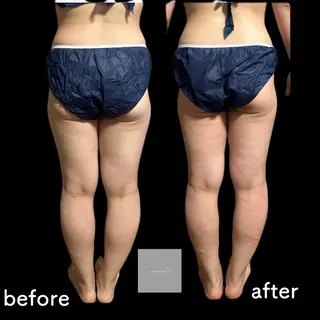 marron所属・痩身ハイパーナイフ ララピールリアボーテのエステ・リラクイメージ