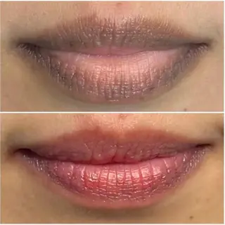 医療提携Ruby所属・医療提携Ruby小顔 ハーブピーリングのその他イメージ