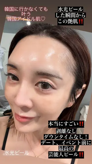 ハーブピーリング/韓国肌管理/フェイシャル/毛穴洗浄/眉毛/顔脱毛【糸脱毛専門】rev所属・ハーブピーリング🌹 毛穴洗浄❤️眉waxのエステ・リラクイメージ