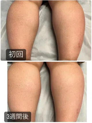 PBS脱毛サロン鶯谷店所属・脱毛/BBL/SHR PBSサロンAirのエステ・リラクイメージ