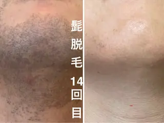 メンズ 肌管理脱毛ピーリング CDFAkasakaのエステ・リラクイメージ