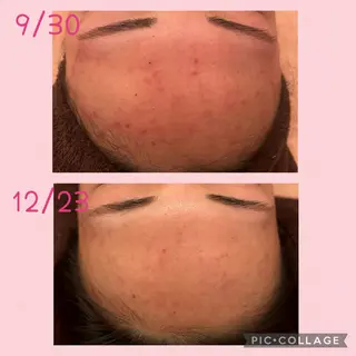 3/25迄ハーブ ピーリングBloomのエステ・リラクイメージ