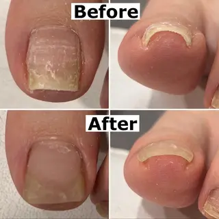 ネイル Mellow nail所属・巻爪無料モデル募集 ✨🦶MEGUMIのネイルデザイン