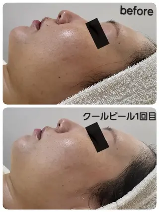 ニキビケア＆ニキビ跡 レゾン京橋店　のエステ・リラクイメージ