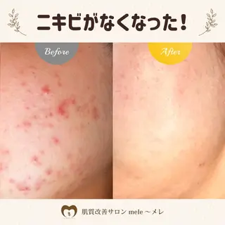 ニキビケア/毛穴/ 赤み/自信の肌✨森園のエステ・リラクイメージ