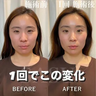 アイブロウ 即小顔♥️美容鍼× ハーブピーリングのその他イメージ