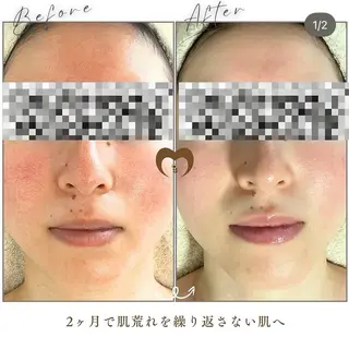 ニキビケア/毛穴/ 赤み/自信の肌✨森園のエステ・リラクイメージ