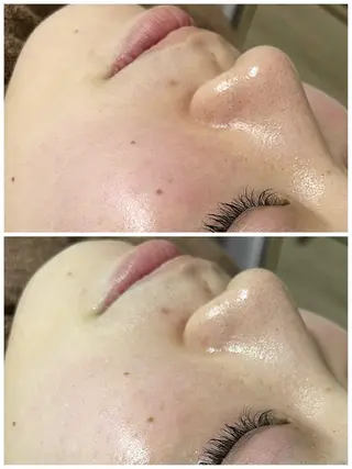 ニキビ／毛穴ケア ハーブピーリングのエステ・リラクイメージ