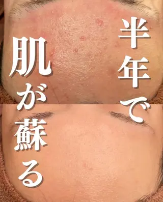 都内で出来る肌管理！ 最短ニキビ改善のエステ・リラクイメージ