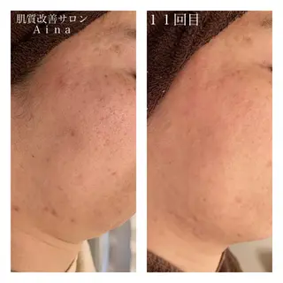 ショート カラー パーマ ヘアアレンジ メンズ キッズ ネイル マツエク・マツパ ニキビ跡専門サロン Ainaのエステ・リラクイメージ