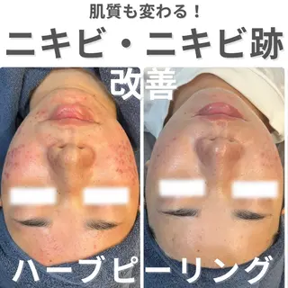 ニキビ・ニキビ跡改善 leoloのエステ・リラクイメージ