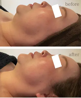 Chalon所属・REVI取扱・肌悩み 毛穴Chalonのエステ・リラクイメージ