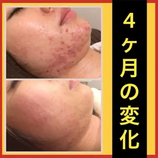学生ニキビ改善🍀 優しい肌質改善のエステ・リラクイメージ