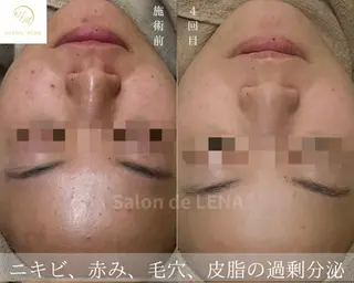 ハーブピーリング・毛穴ケア専門サロンSalon de LENA 栄店所属・ハーブピーリング専門 サロンドレナ　白藤のエステ・リラクイメージ