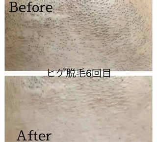 メンズ 医療提携メンズ脱毛 CDFAkasakaのエステ・リラクイメージ