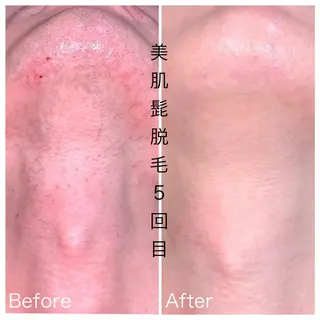 メンズ 医療提携メンズ脱毛 CDFAkasakaのエステ・リラクイメージ