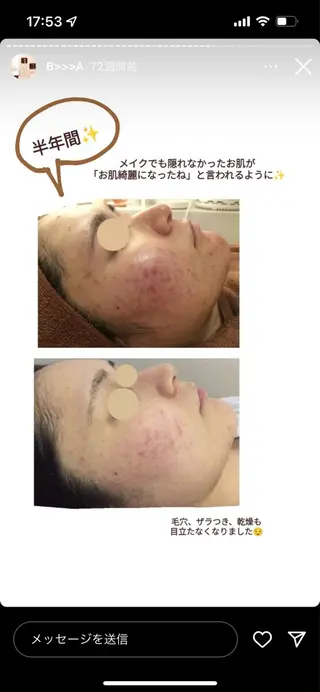 ニキビ跡改善専門🔥 医療にはできない改善のエステ・リラクイメージ