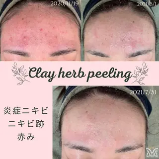 【剥離ありハーブピーリング専門エステ】cerisier BEAUTÉ 原宿所属・cerisier BEAUTÉのエステ・リラクイメージ