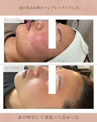 NARIS BEAUTY STATION　デ・アイム あべのルシアス所属・ニキビ跡/毛穴/ 肌質改善/北村ももこのエステ・リラクイメージ