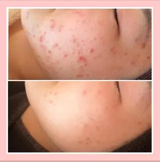 セミロング カラー パーマ ヘアアレンジ メンズ キッズ ネイル マツエク・マツパ アイブロウ 🔥3か月で肌革命 🔥ニキビ専門店のエステ・リラクイメージ